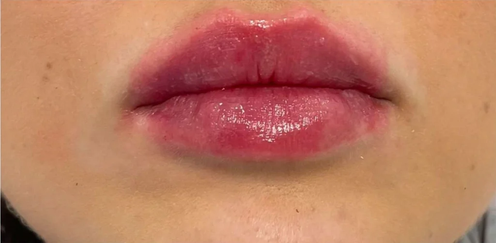 Powiększanie Ust Kielce